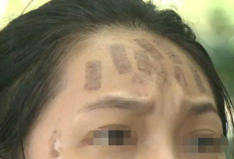 成都光子嫩膚價(jià)格，科技重塑肌膚之美